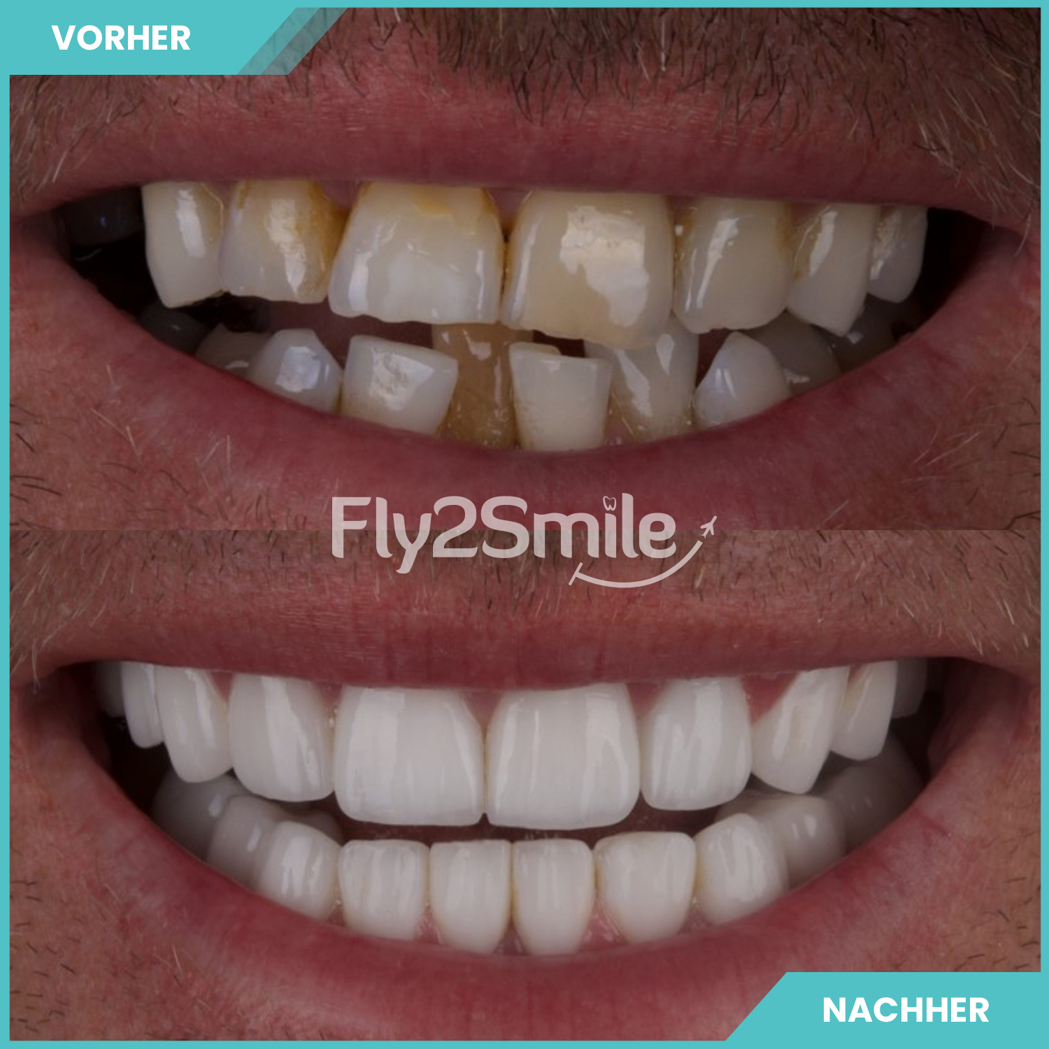 Kundenbild groß 14 Veneers & Zahnimplantate – Zähne machen lassen in der Türkei mit Fly2Smile