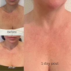 Before-and-after photo showing skin appearance 1 day post treatment.