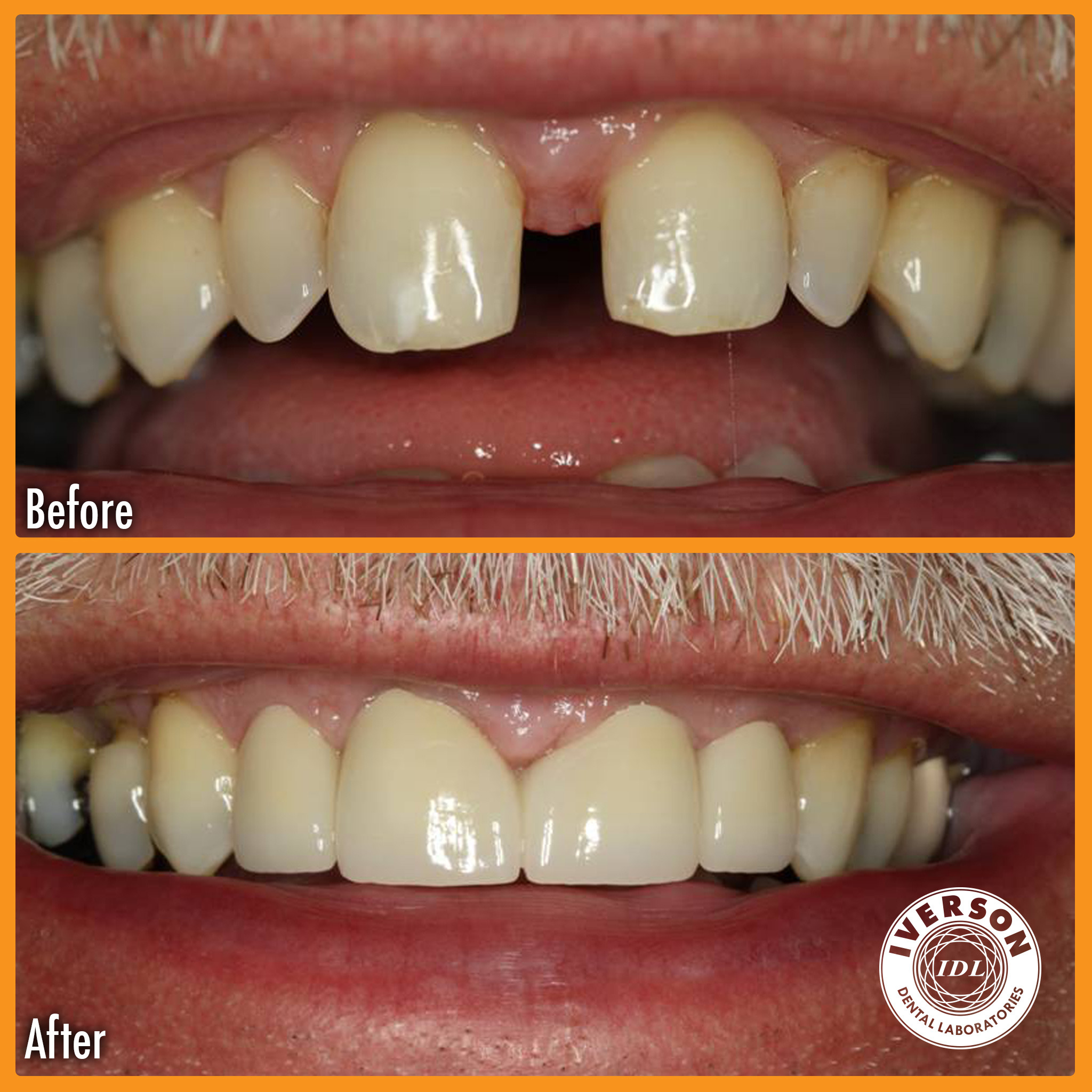 A patient with noticeable gaps and misalignment in their teeth before, smiling confidently with a seamless, aligned, and aesthetically pleasing smile after the restoration.