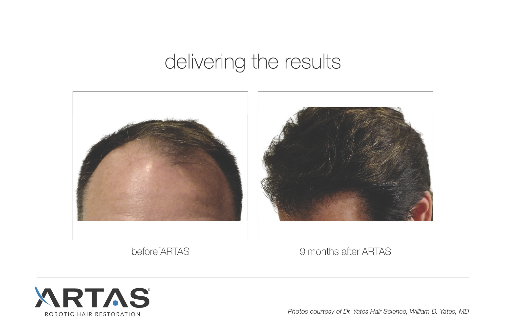 Images Follicl MD - Hair transplant - Greffe de cheveux