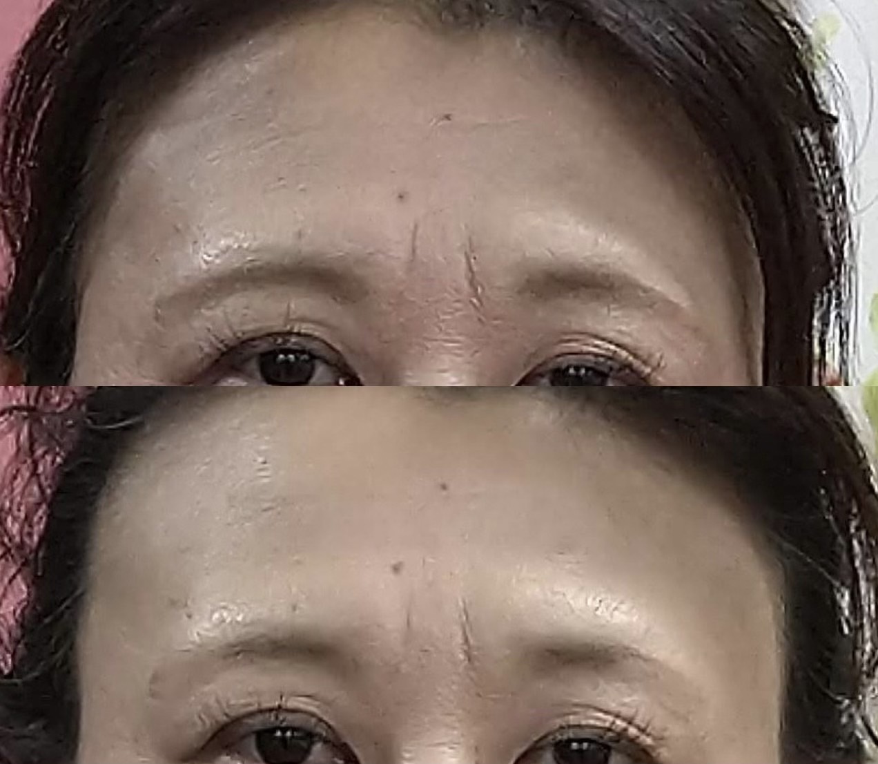 Images 目元・口元のたるみ&眉間シワ改善専門サロン