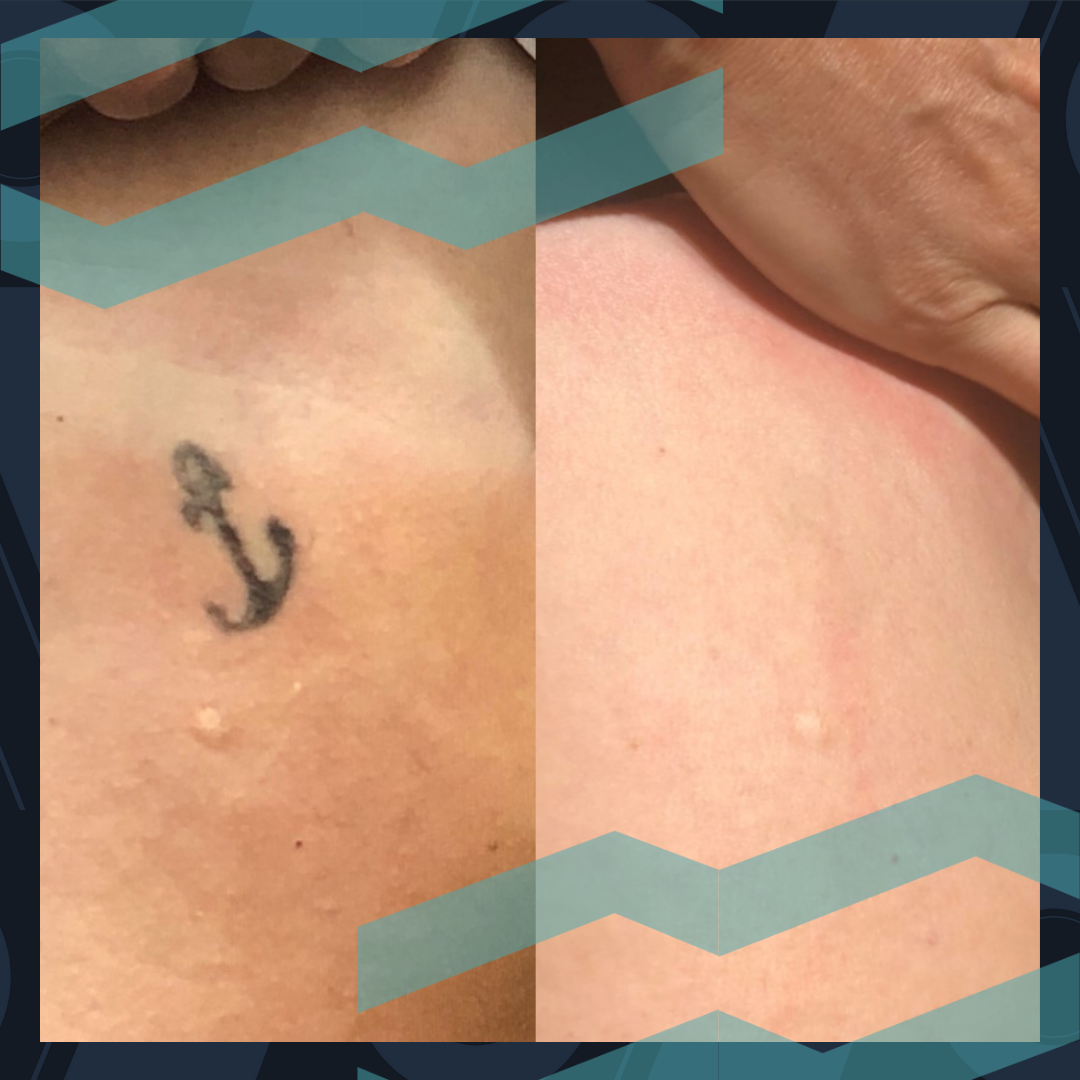 Removery Tattoo Removal & Fading à Ottawa: Before & After Tattoo Removal