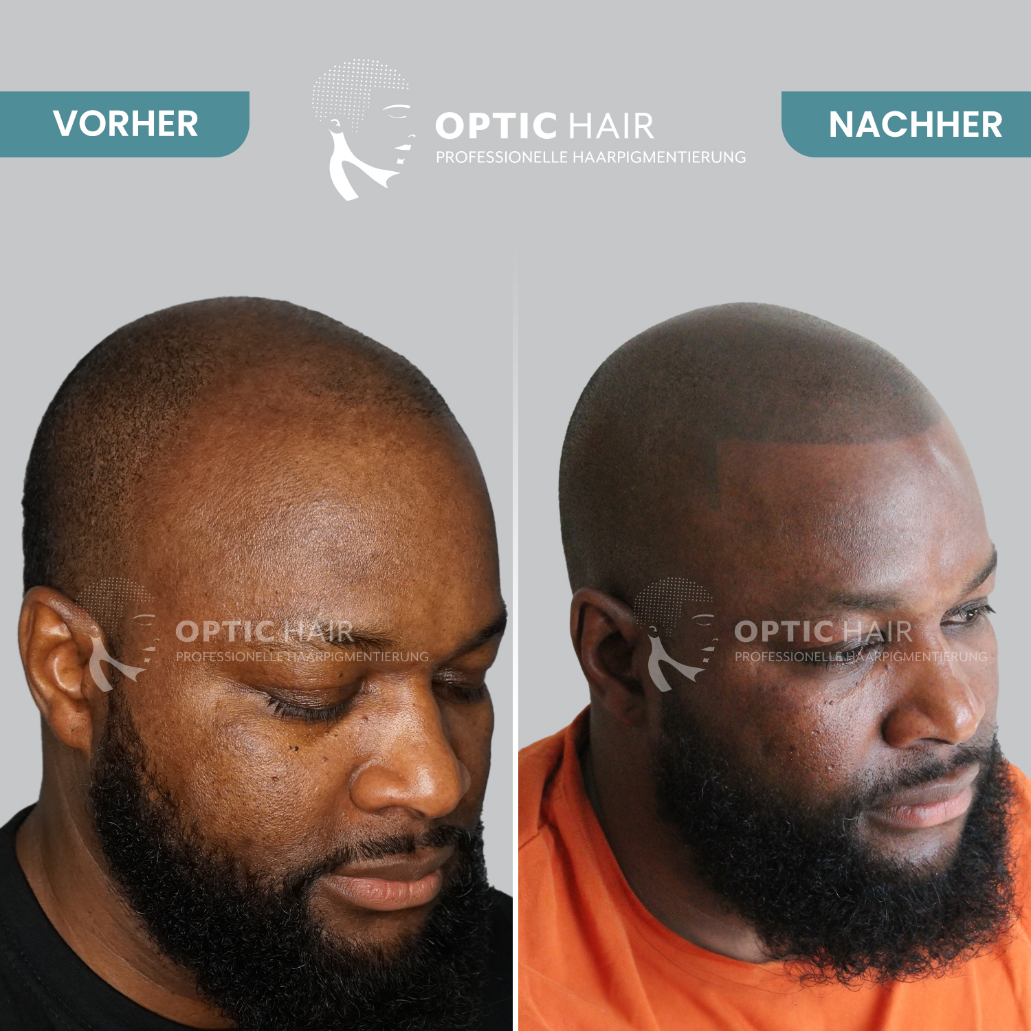 Kundenbild groß 14 Haarpigmentierung Köln | OpticHair