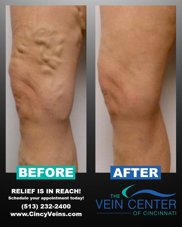 Images The Vein Center of Cincinnati, LLC