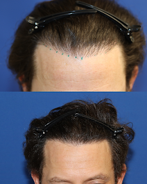 Images BKS Hair Restoration