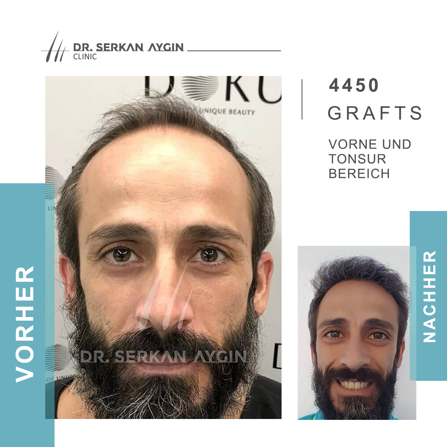 Kundenbild groß 18 Dr Serkan Aygin | Niederlassung Berlin | Haartransplantation Türkei