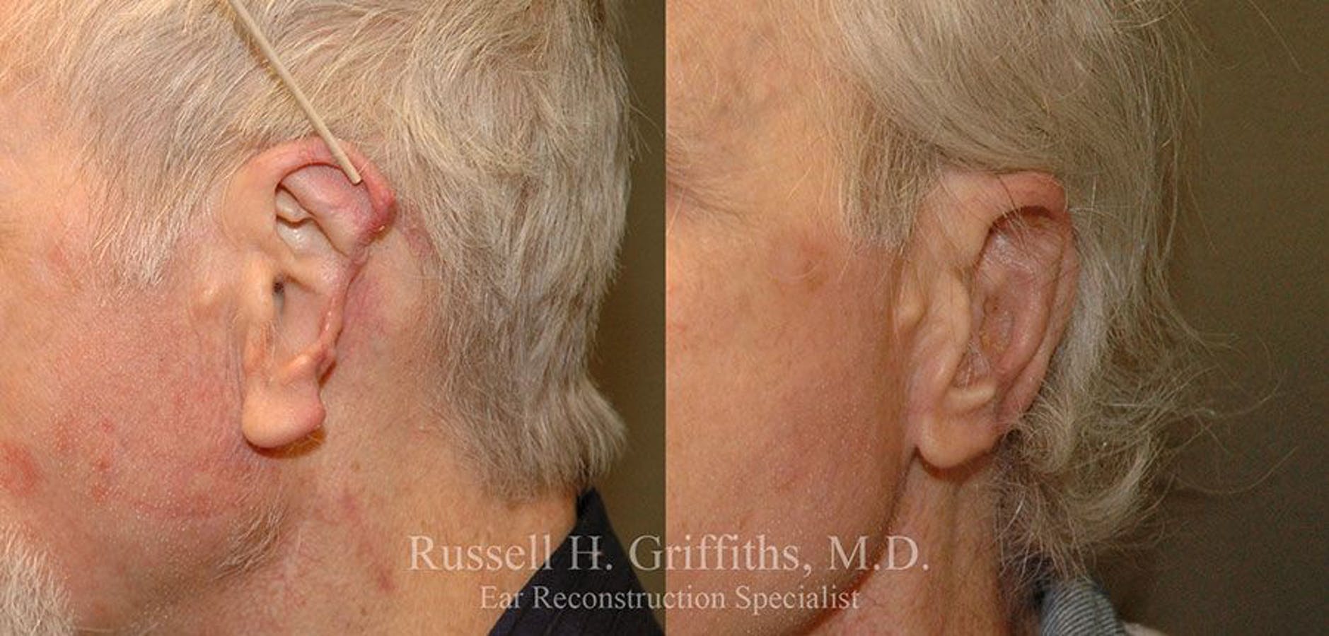 Results of Russell H. Griffiths, MD | Boise, ID