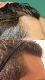 Images BKS Hair Restoration