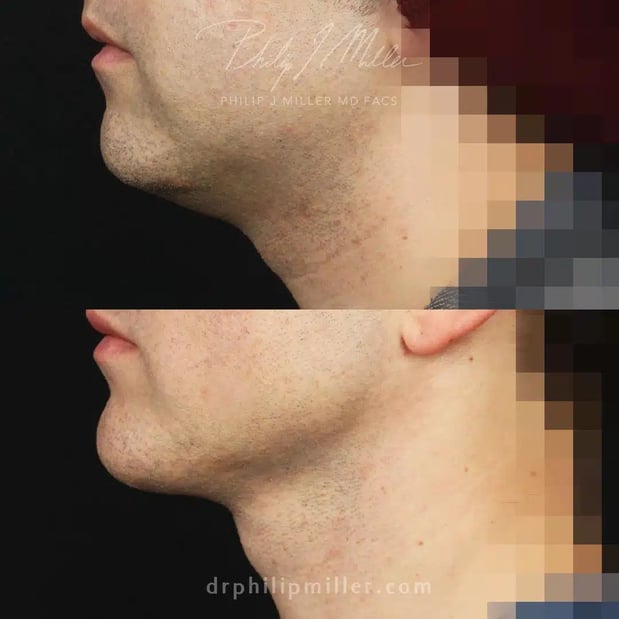 Images Dr. Philip Miller - #1 Facelift and Rhinoplasty Surgeon in New York