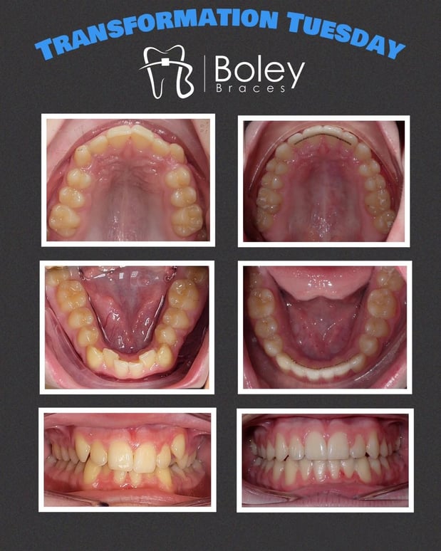 Images Boley Braces