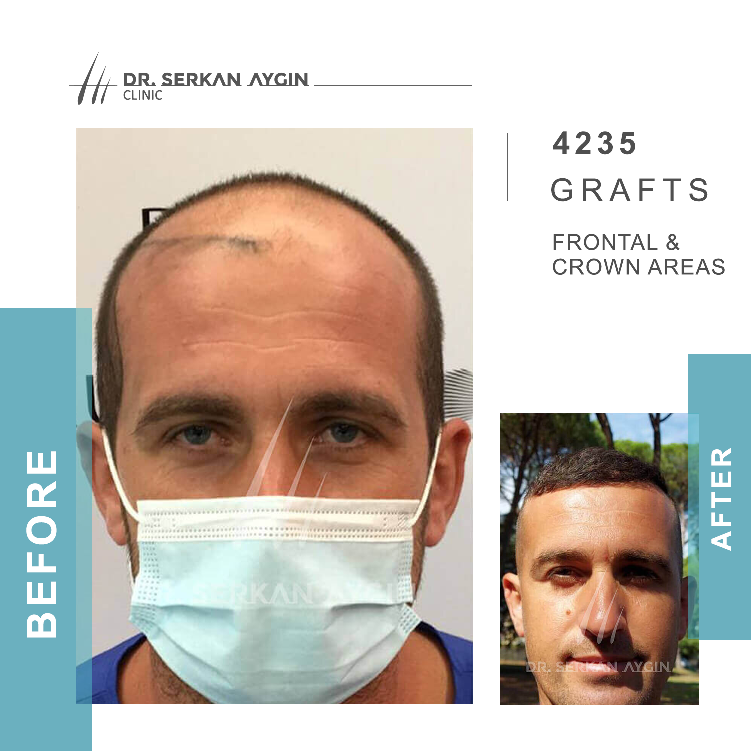 Images Hair Transplant Turkey | Dr. Serkan Aygin | London Branch Office