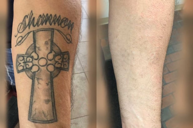 Images TakeTatt Tattoo Removal