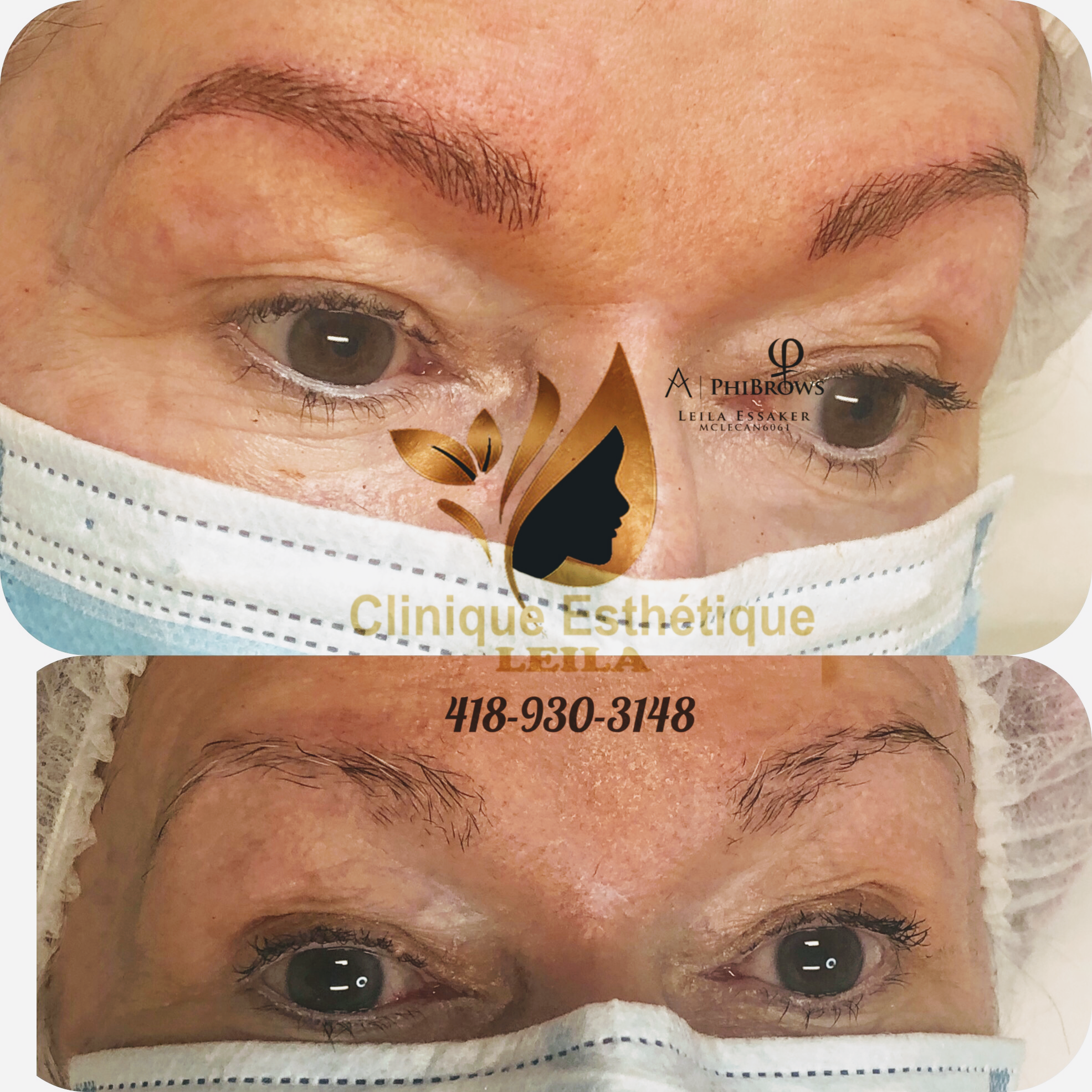 Images Clinique d'Esthétique Leila - Hydrafacial, Microblading, Épilation Laser Sainte-Foy