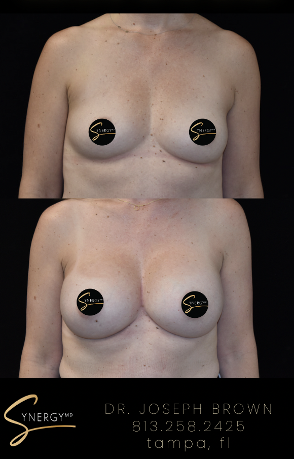 Before & After from SynergyMD Plastic Surgery | Tampa, FL