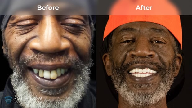 Images Smile Now Milwaukee Dentures and Implants