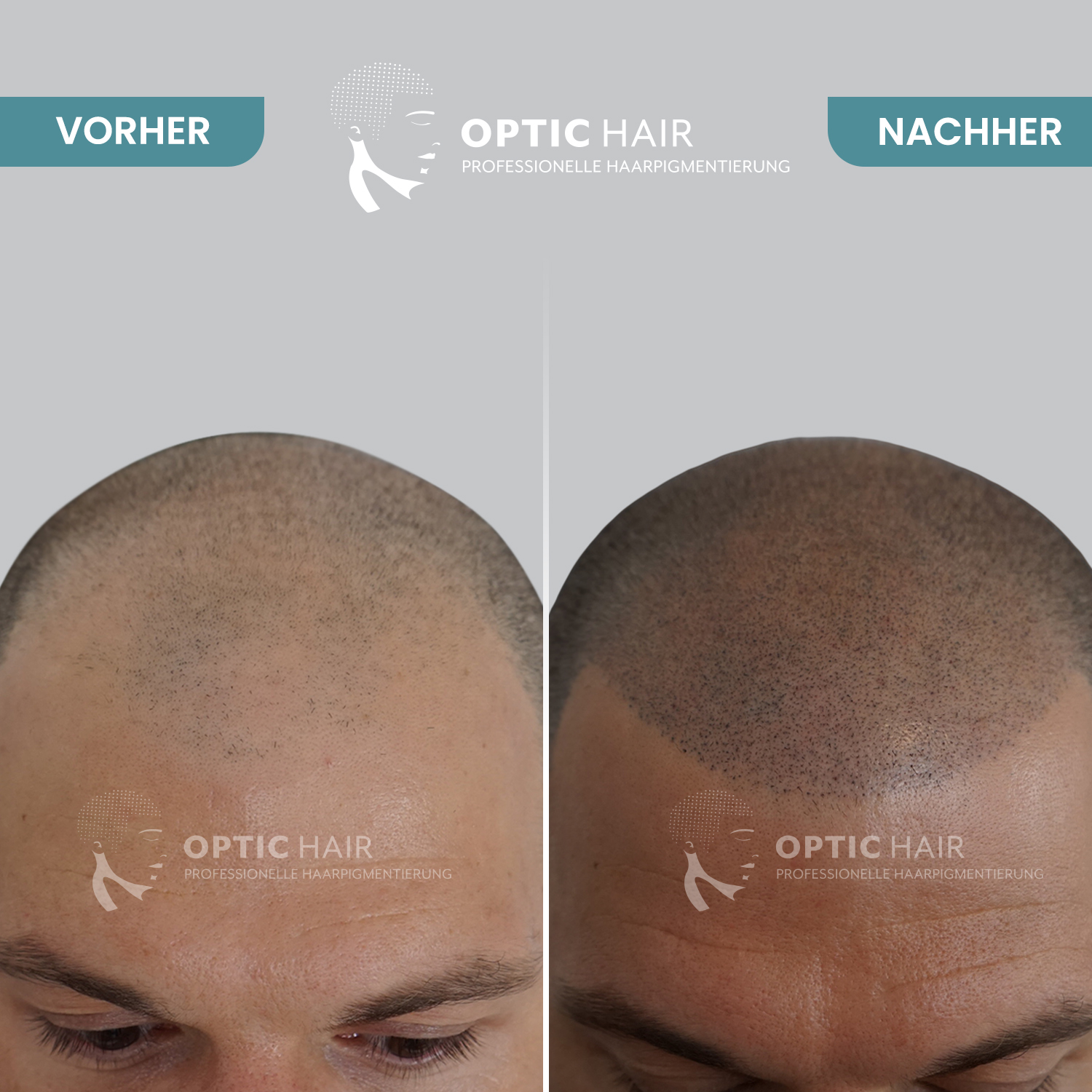 Haarpigmentierung Vorher Nachher Bilder Optic Hair