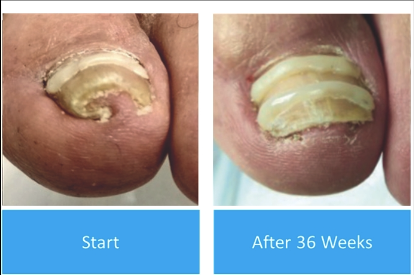 Before & After from Advanced Foot & Ankle Specialists | Avon, CT