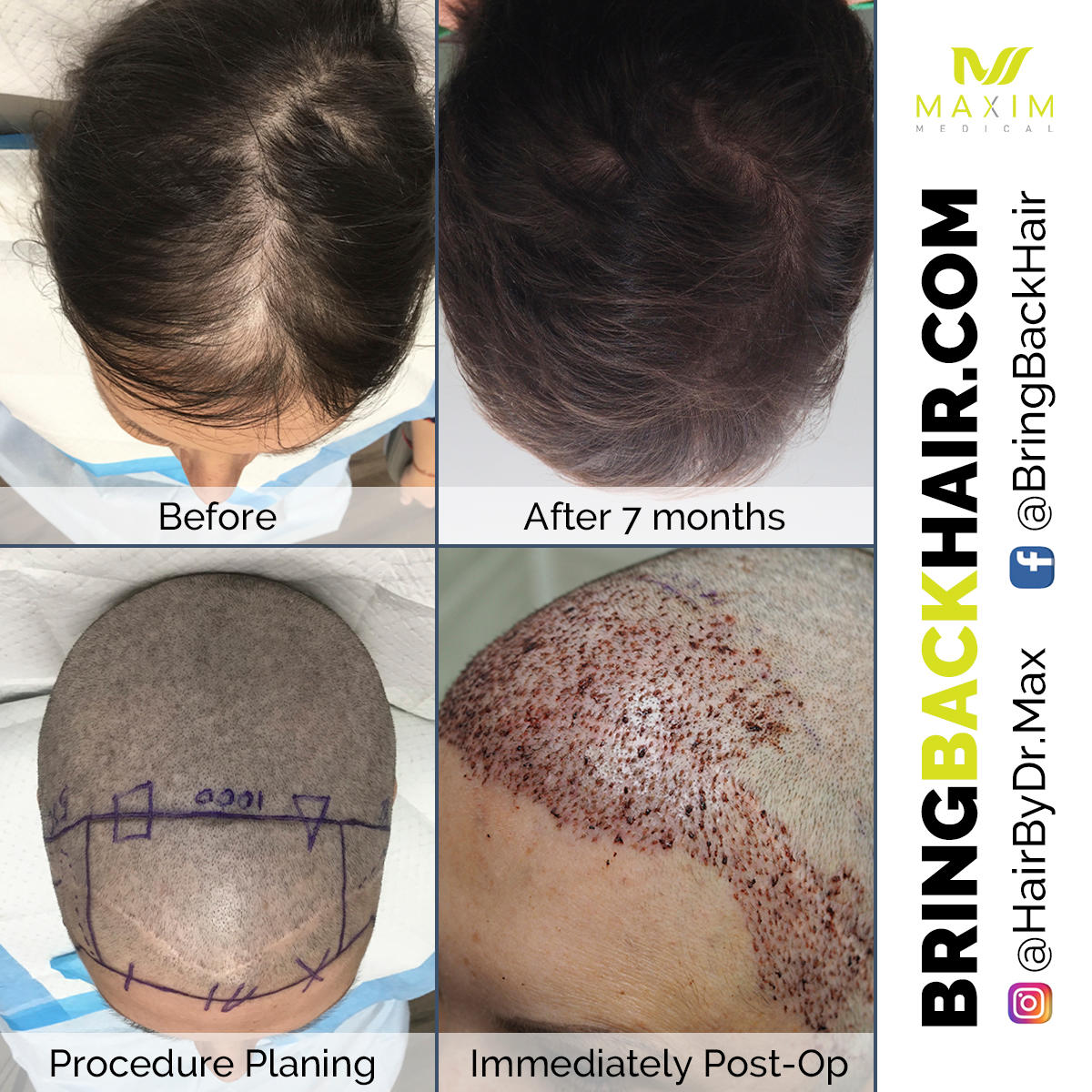 It’s time to invest in the new you!
ARTAS robotic technology delivers promising hair restoration in just a few months. Here are the results of one of our ARTAS patients who achieved their dream results after undergoing the procedure. 
Take the first step towards natural, permanent hair today! Give us a call for a free consultation: (833) MOR-HAIR
(833) 667-4247