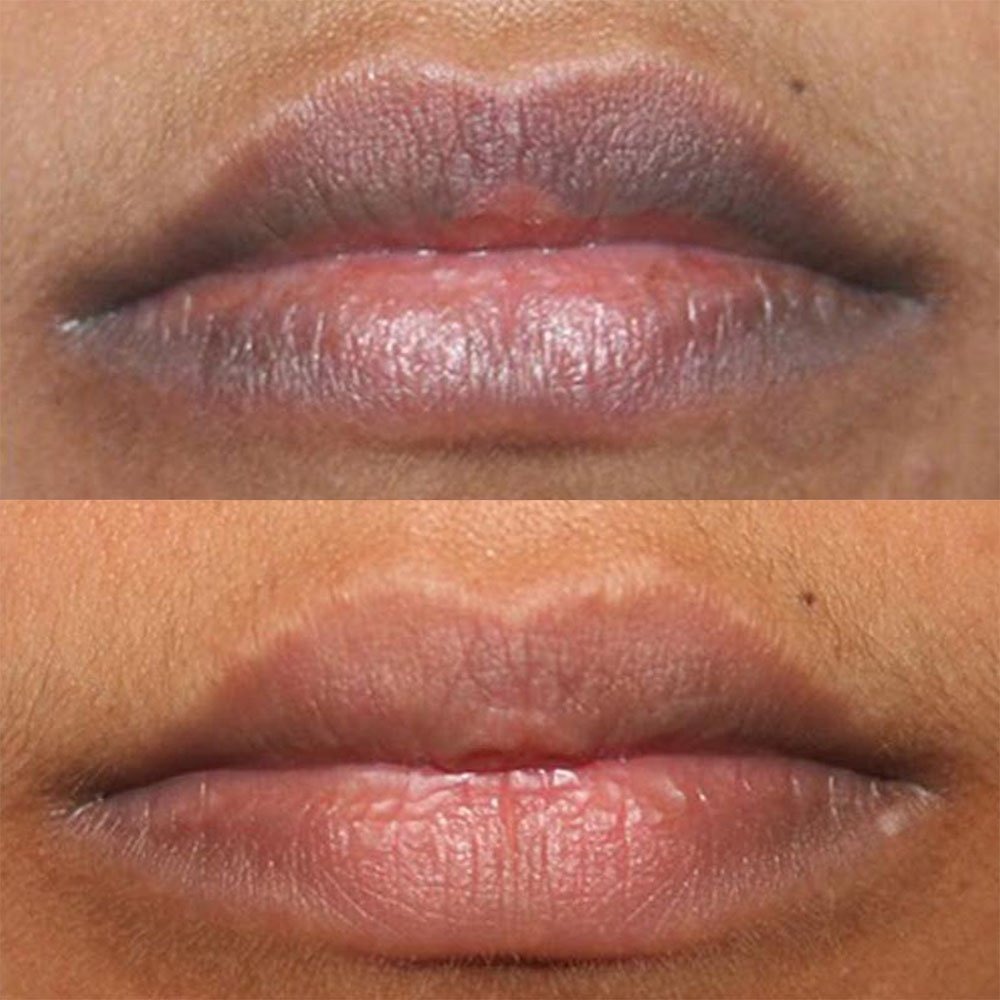 Dark lip neutralization in Colorado Springs by Marysol Gill, designed to soften dark or cool-toned lips, improve lip color balance, and create a brighter, more even appearance. A professional lip lightening and permanent makeup treatment for clients who want natural-looking lips with softer tone, better definition, and a fresher look.
