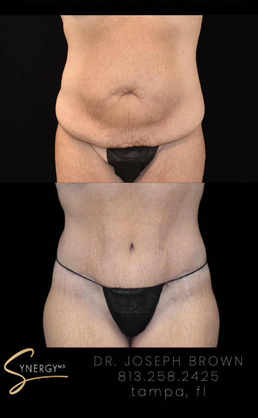 Before & After from SynergyMD Plastic Surgery | Tampa, FL