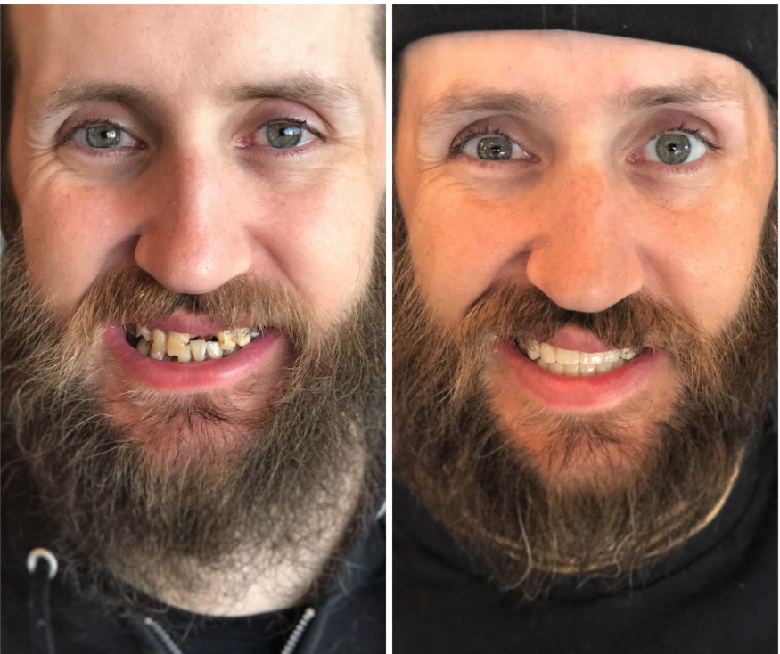 Before and After from Stubbs Dental | Layton, UT