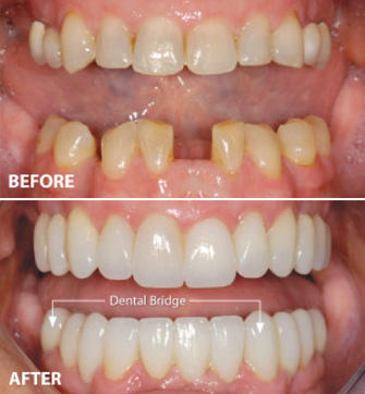 Before and After from Batista Family Dental | West New York, NJ