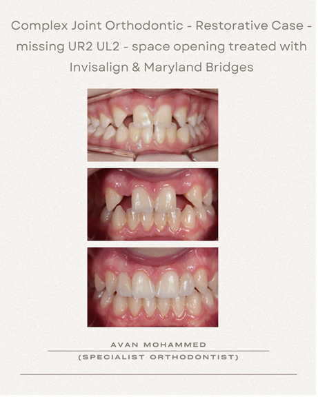 Every smile has a unique story. ????

In this case, a patient with missing upper lateral teeth underwent Invisalign treatment to create the perfect space for replacement teeth. The smile was then completed with Maryland bridges, delivering a natural and harmonious result.

A wonderful example of how modern orthodontics and restorative dentistry can work together to transform both function and aesthetics.