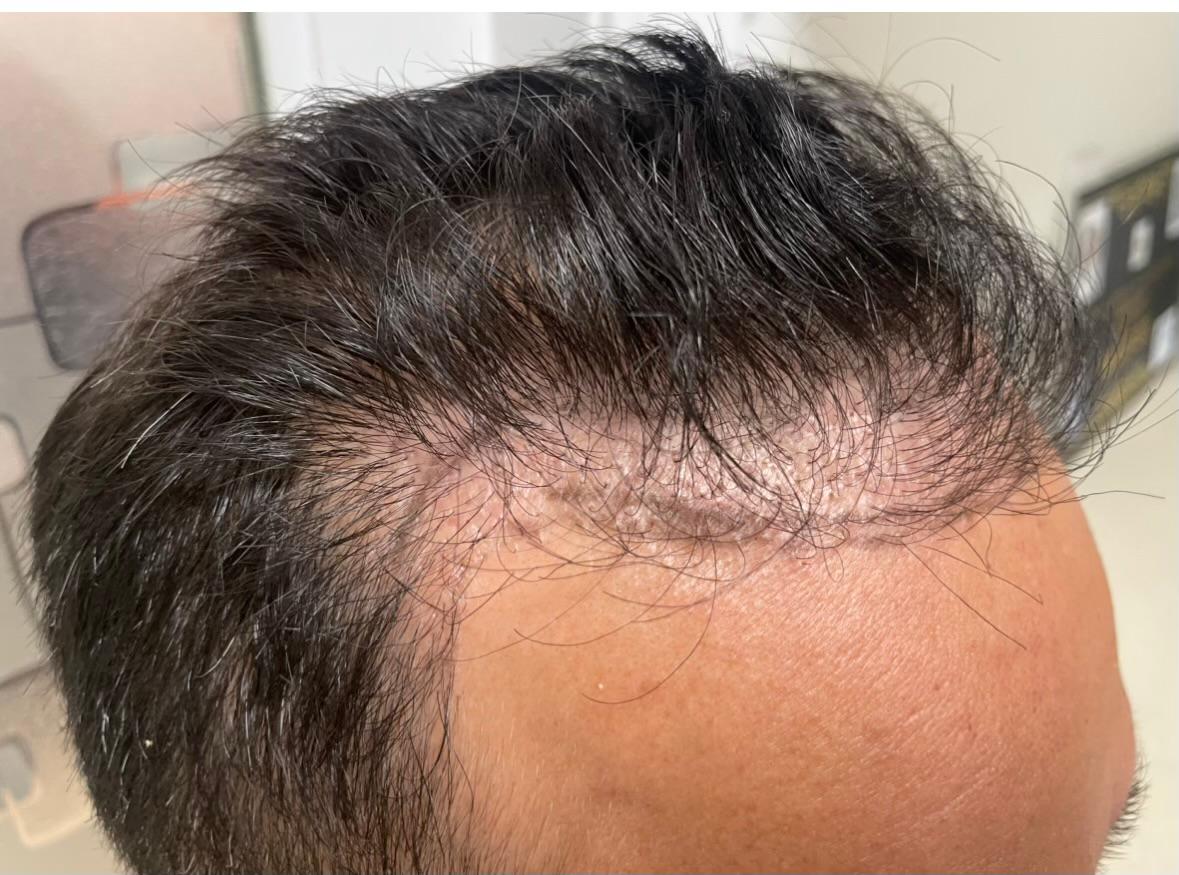 Patient with poor hairline from another clinic.