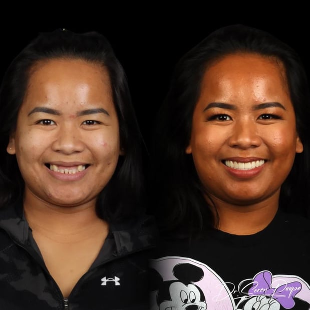 Images Smile Now Denver Dentures and Implants