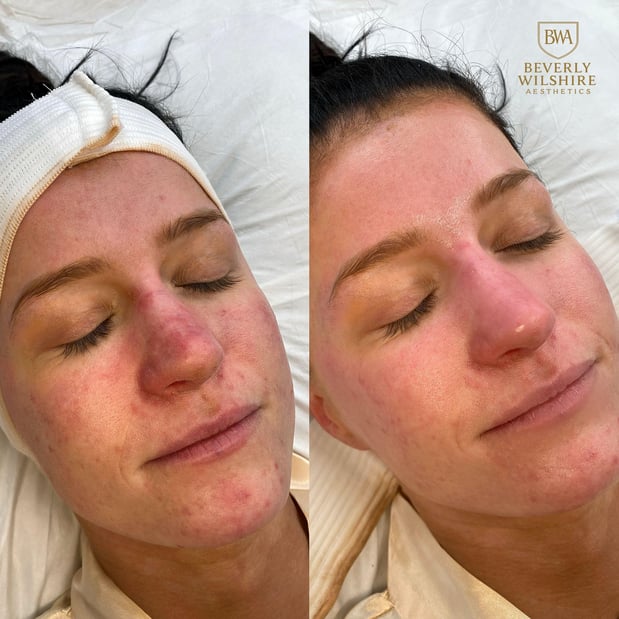 Images Beverly Wilshire Aesthetics Beverly Hills Medical Spa for Botox, Morpheus8, IPL, Lip Fillers