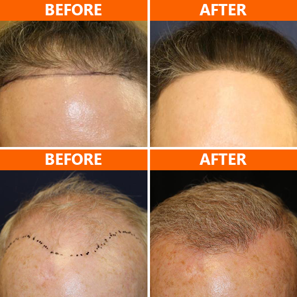 PRP hair treatment in San Diego helps restore and stimulate hair growth by injecting your natural occurring blood platelets into the area(s) of your scalp where there is hair loss. PRP hair restoration therapy can help regenerate your hair follicles without the need for surgery.