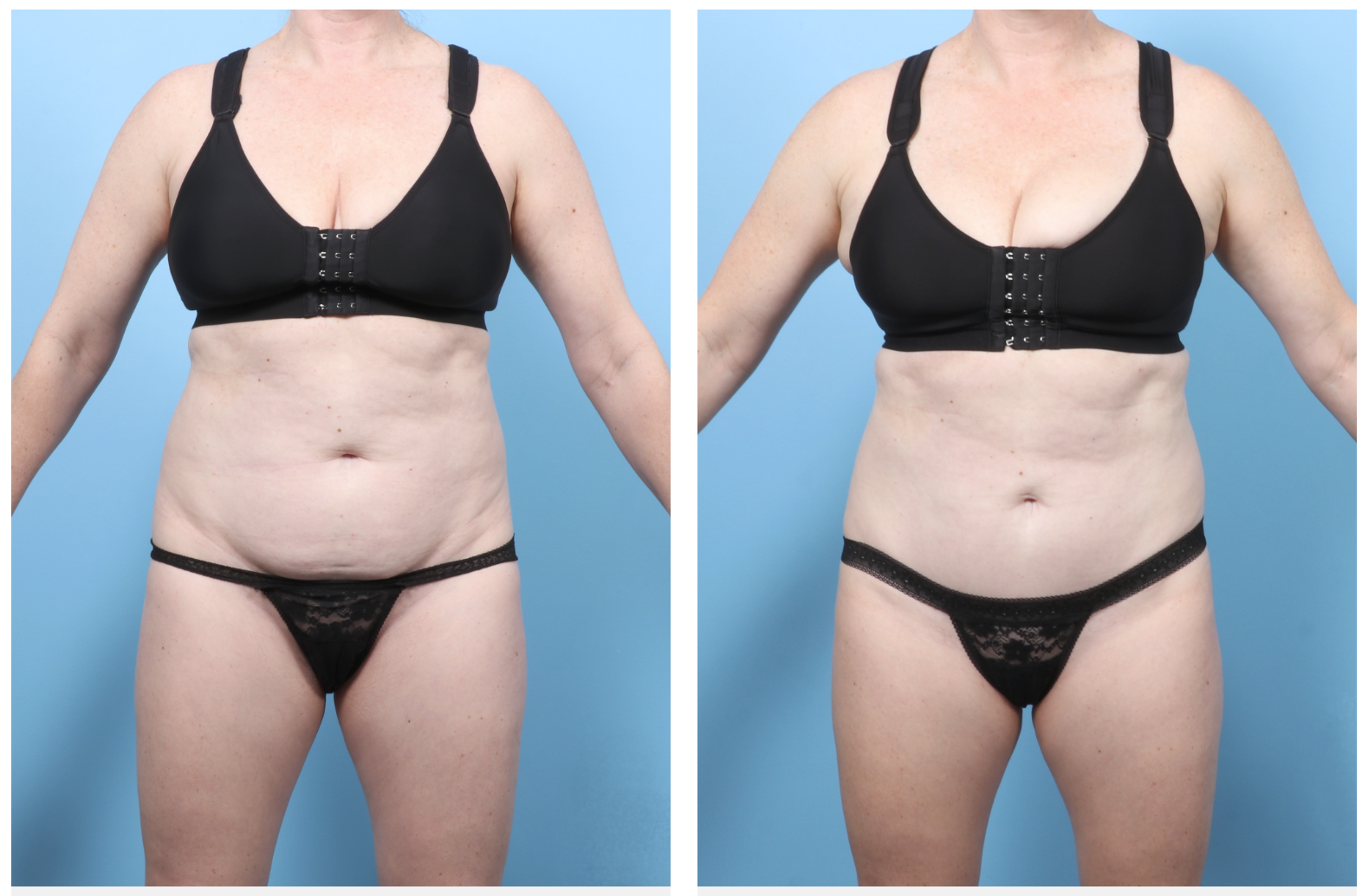 Dr. Drew Davis Sacramento Tummy Tuck 