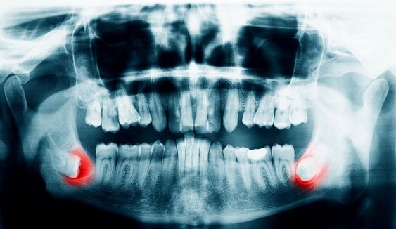 Wisdom Tooth Extraction in Charlotte, NC