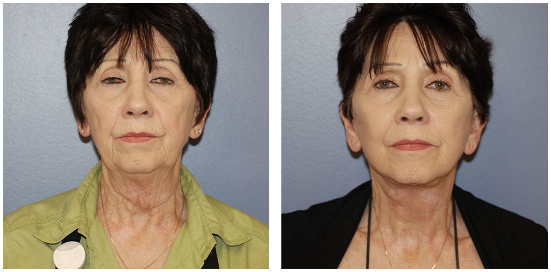 Facelift in San Francisco, CA with Dr. Ginger Xu.