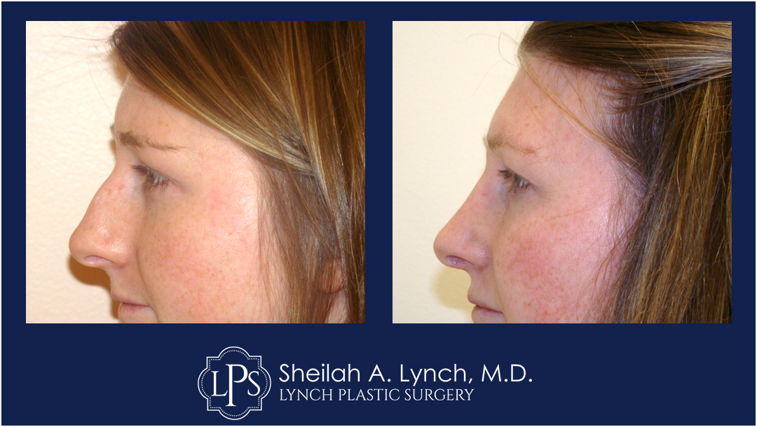 Rhinoplasty, Nose Reshaping Before & After Patient Chevy Chase Maryland. Plastic Surgeon Near Me Sheilah A. Lynch, MD