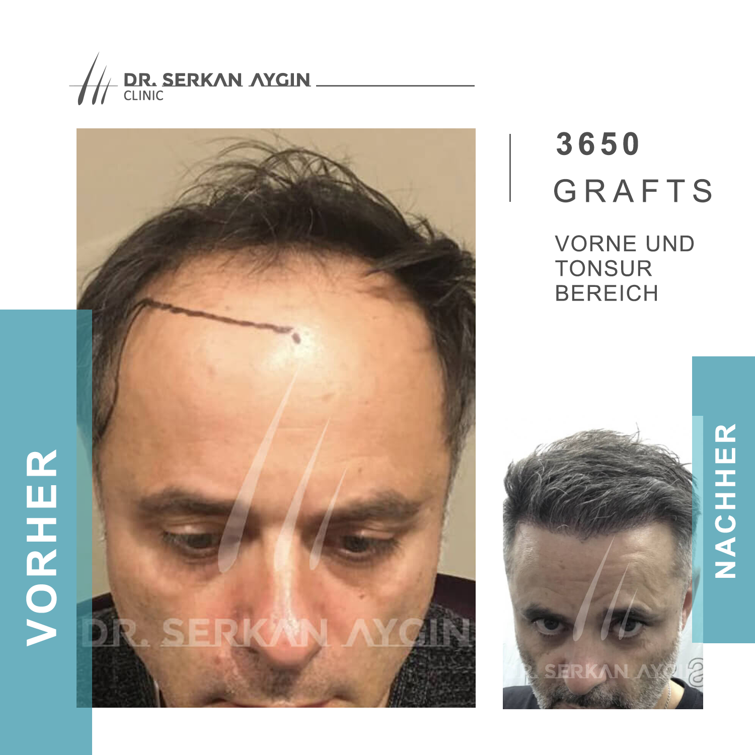 Kundenbild groß 6 Dr Serkan Aygin | Niederlassung Berlin | Haartransplantation Türkei