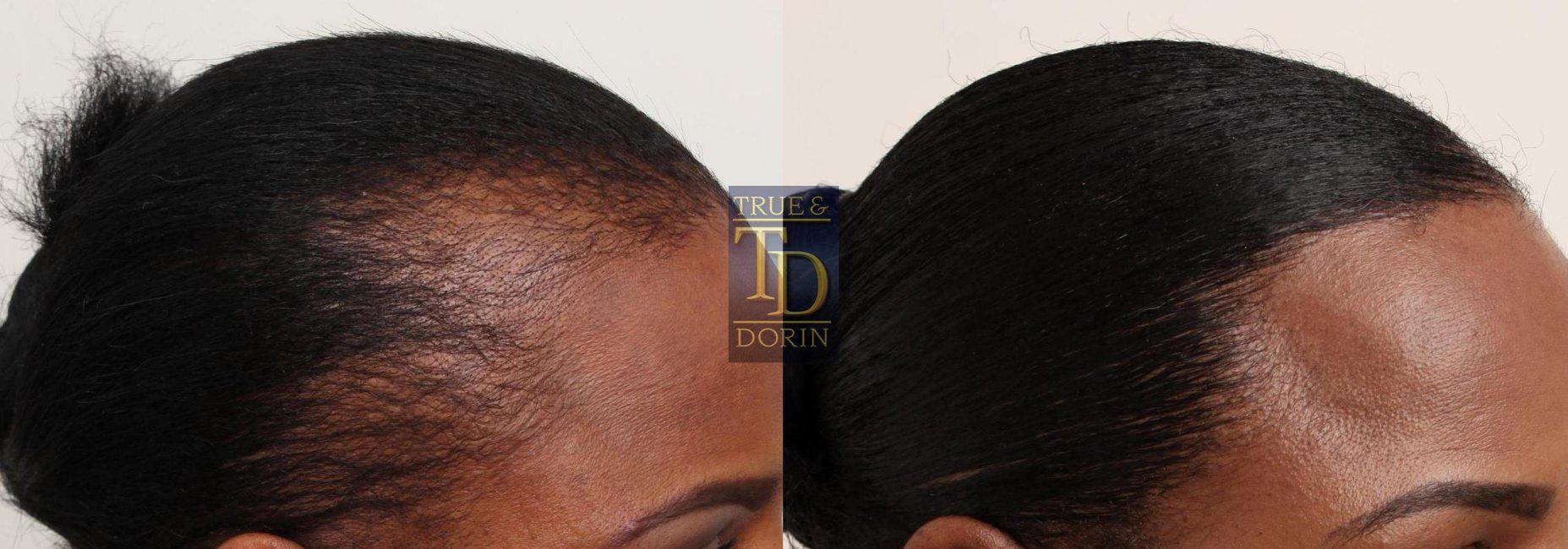 Before and After at The Hair Loss Doctors | New York, NY