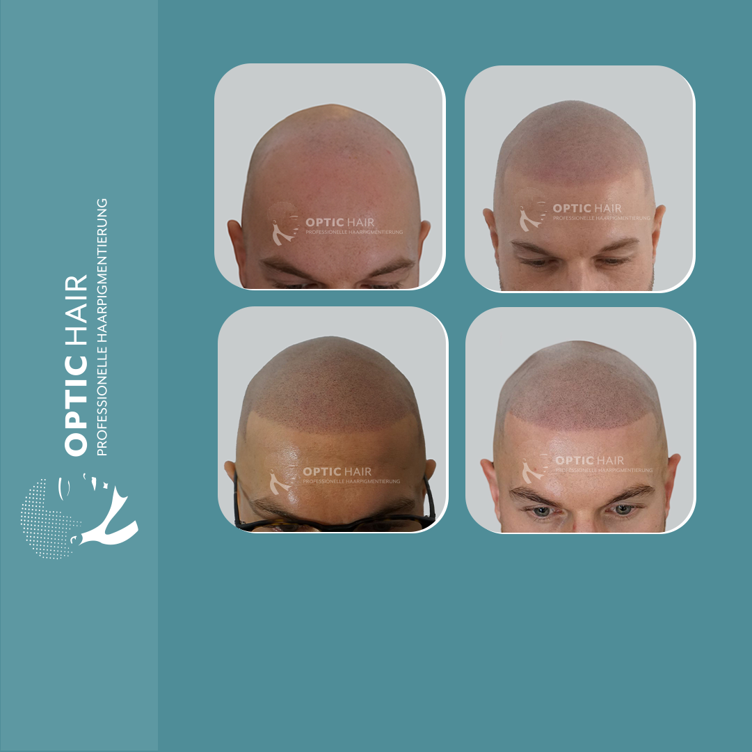 Kundenbild groß 9 Haarpigmentierung Köln | OpticHair