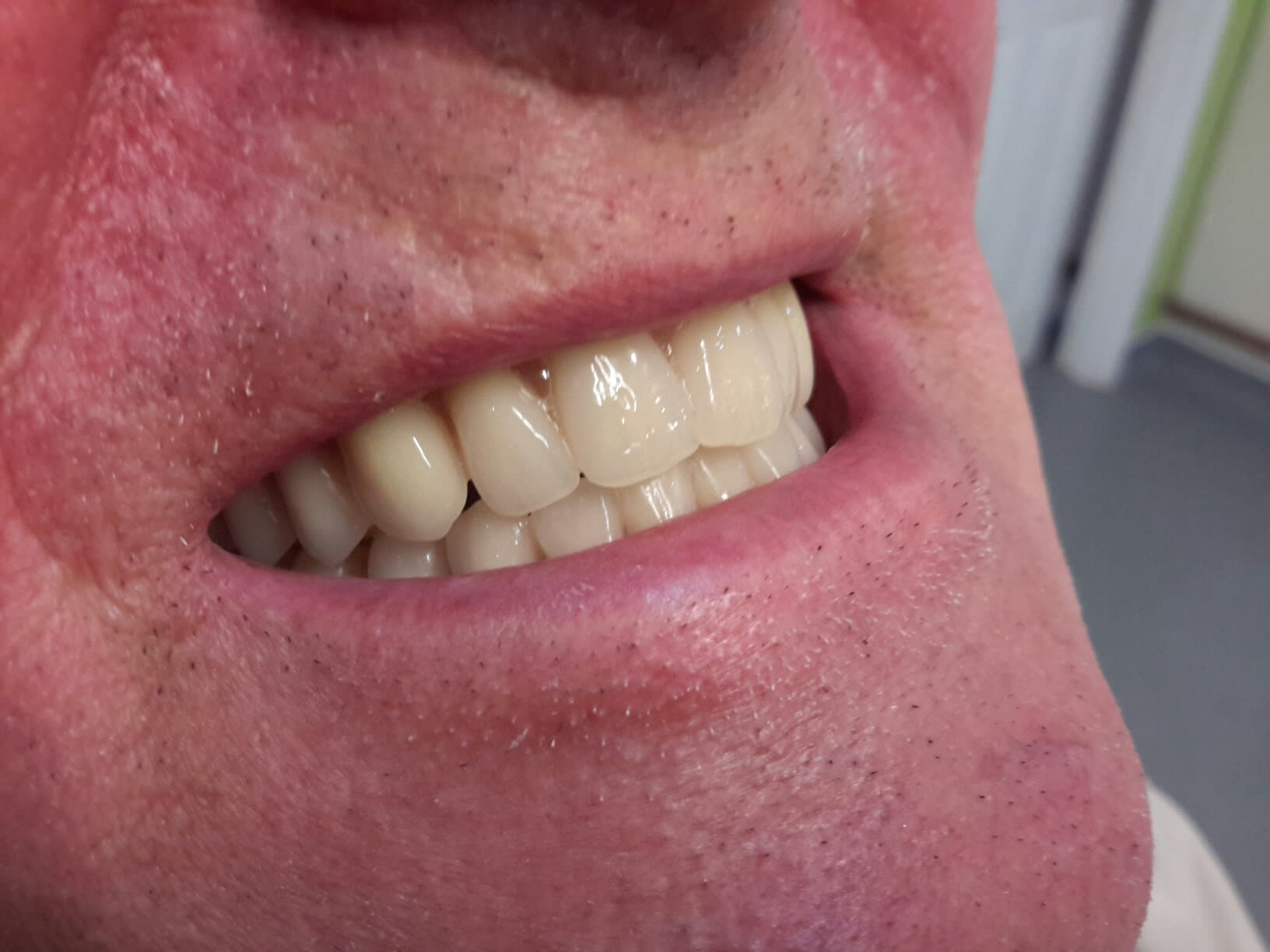 Simply Dentures Bilston 01902 664634