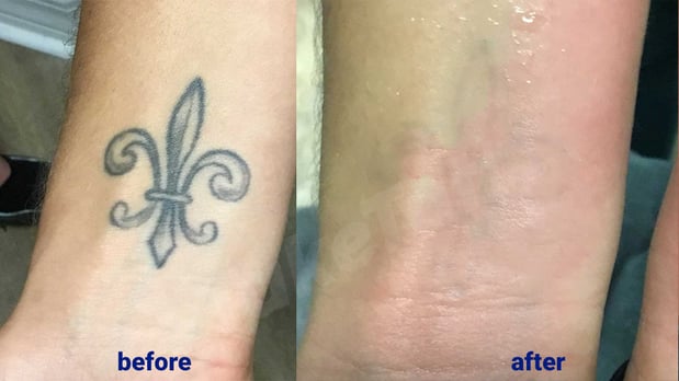 Images TakeTatt Tattoo Removal