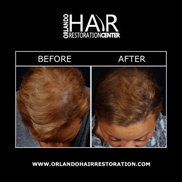 Images Orlando Hair Restoration Center