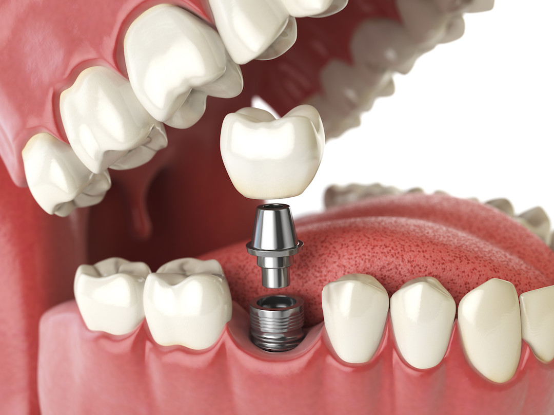 Image 5 | Mass Dental Associates