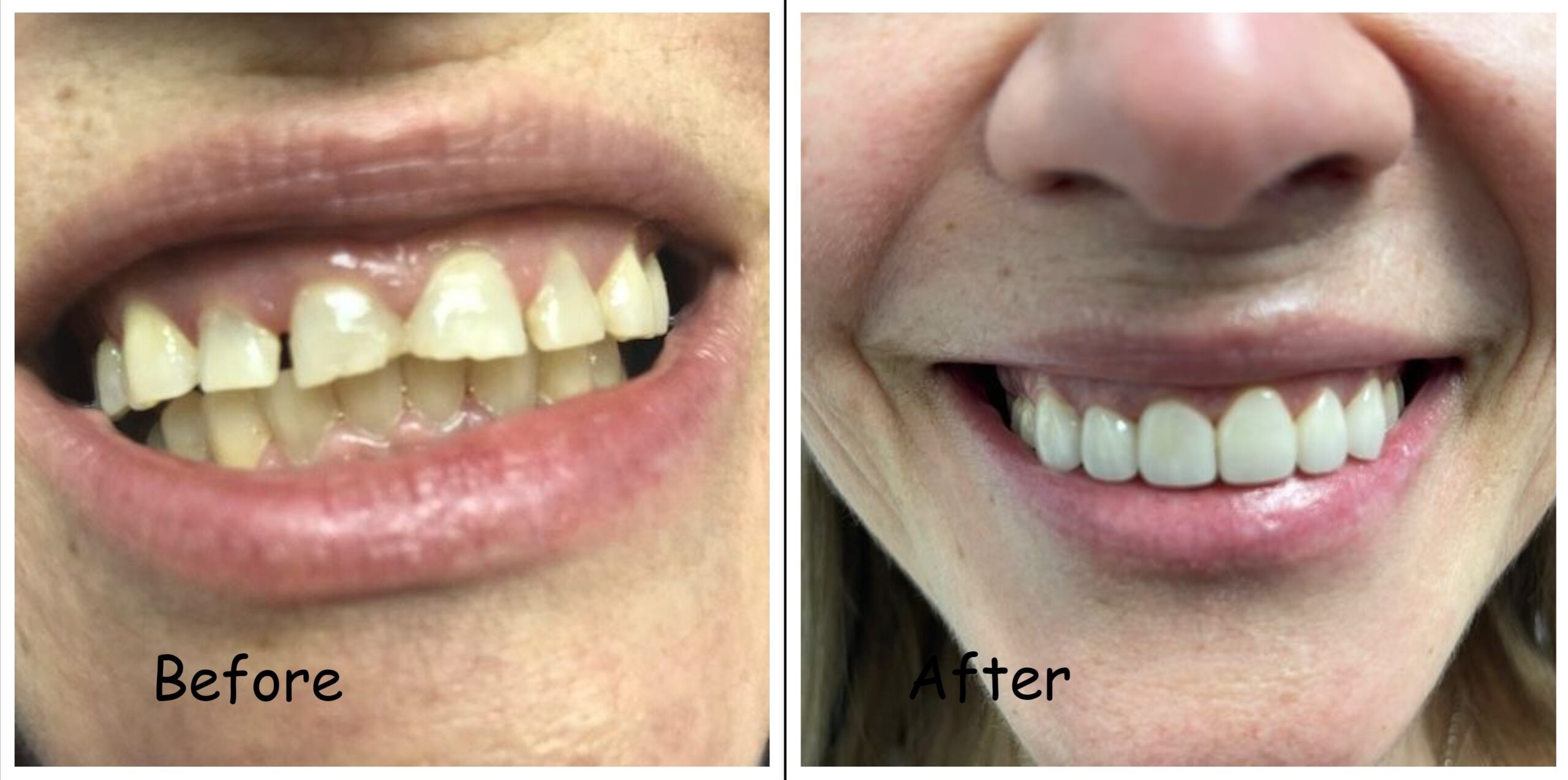 Before-and-after cosmetic dentistry result showing a brighter, more even smile with improved tooth s 