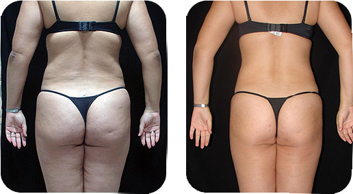 Transformation rapide Minceur: SPM DRAINAGE + RADIOFREQUENCE Transformation rapide Minceur: SPM DRAINAGE + RADIOFREQUENCE