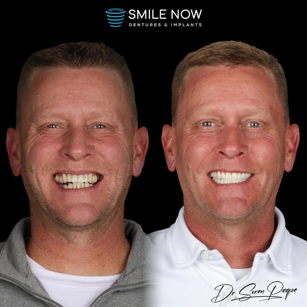 Images Smile Now Denver Dentures and Implants