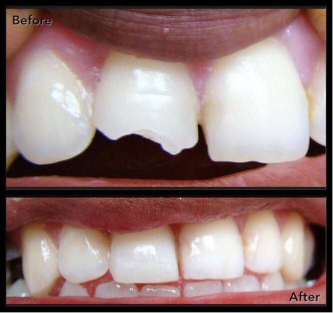 Before-and-after cosmetic dental restoration showing a chipped front tooth and the repaired result,  