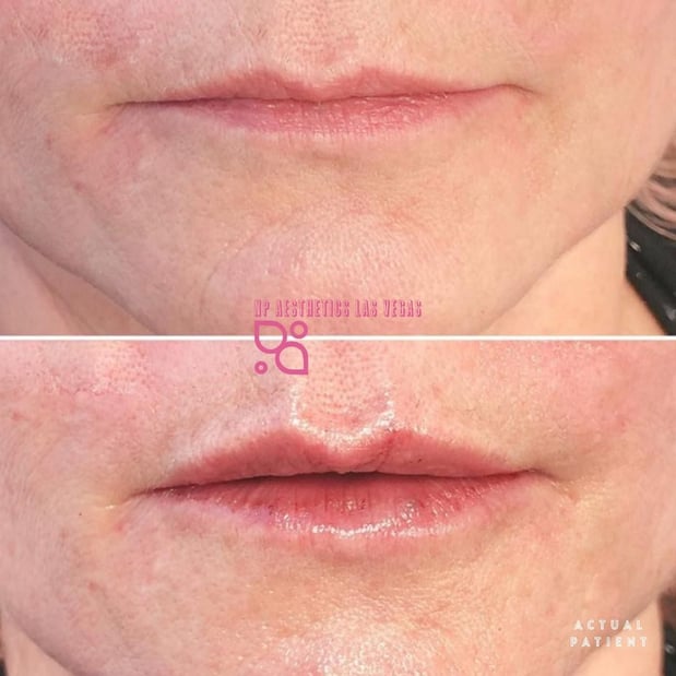 Images NP Aesthetics Las Vegas