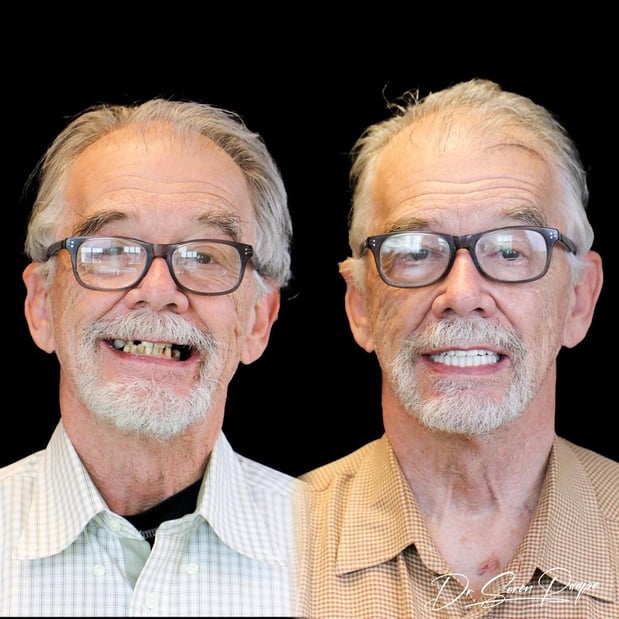 Images Smile Now Denver Dentures and Implants