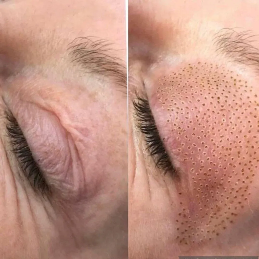This image shows a before-and-after comparison of a Fibroblast Plasma Skin Tightening treatment around the eye area. The left side shows the skin before the procedure, with visible fine lines and sagging.
The right side shows the skin immediately after treatment, featuring tiny plasma dots that indicate where the skin has been tightened and stimulated for collagen production.
This non-invasive cosmetic procedure helps reduce wrinkles, lift sagging skin, and rejuvenate the eye area without surgery.