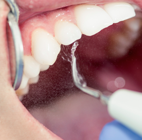 Warren's Sparkle Dental has the Specialty to Diagnose and Treat Periodontal Disease
